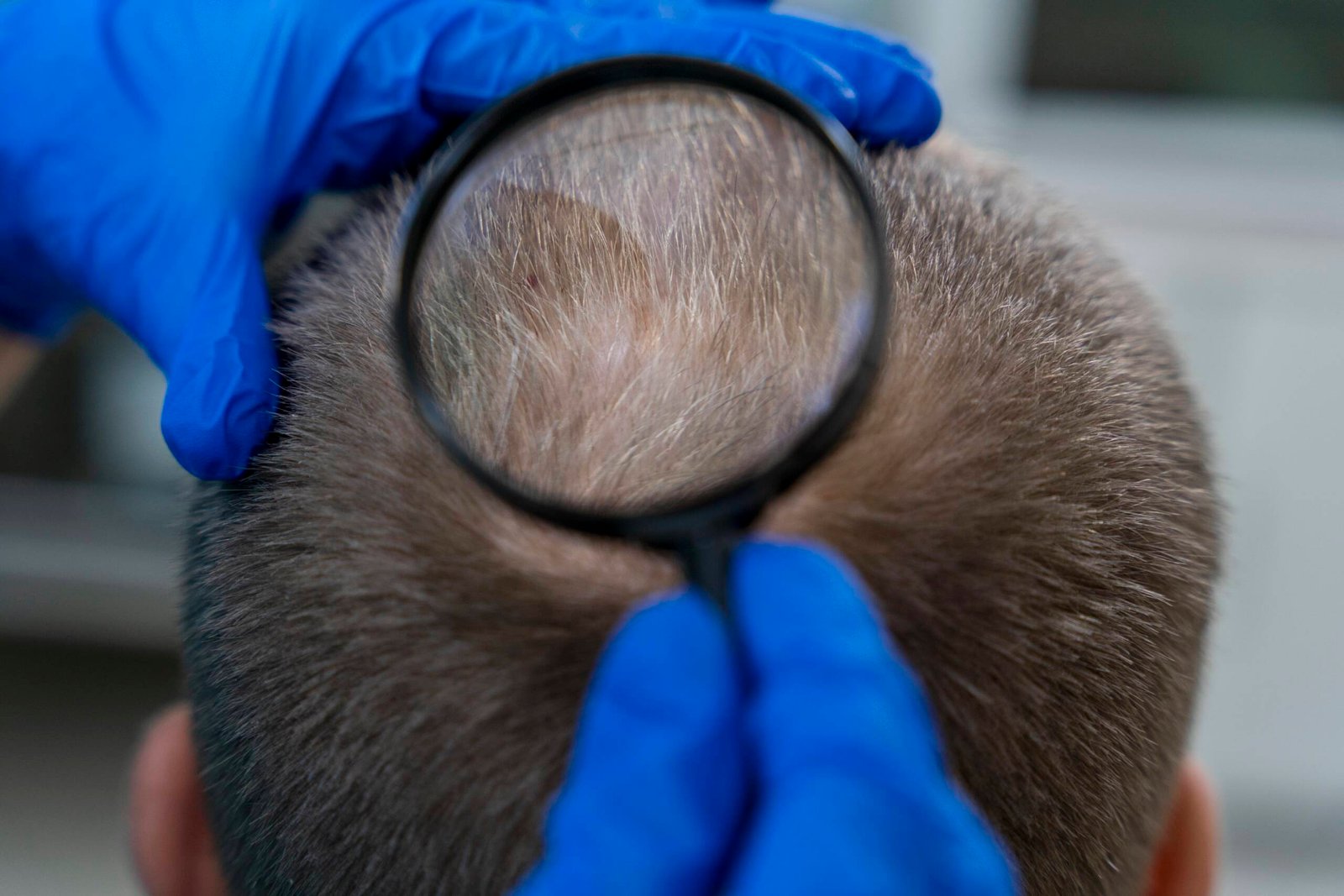 Stem Cell Hair Transplant