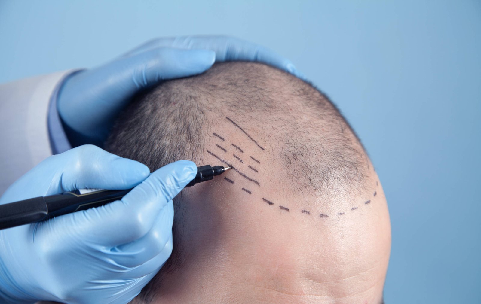 DHI Hair Transplantation