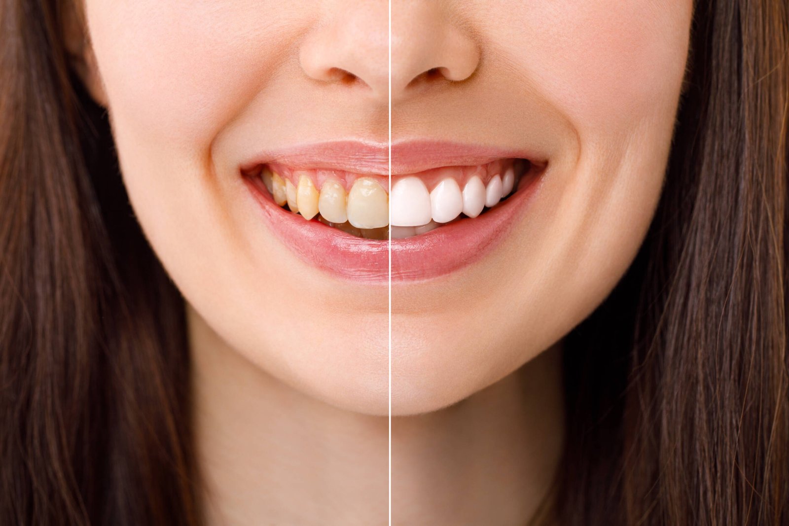 TOOTH WHITENING